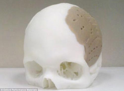 美国一患者75%大脑颅骨由3D打印模型替代
