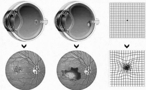 新给药技术为黄斑变性患者带来希望