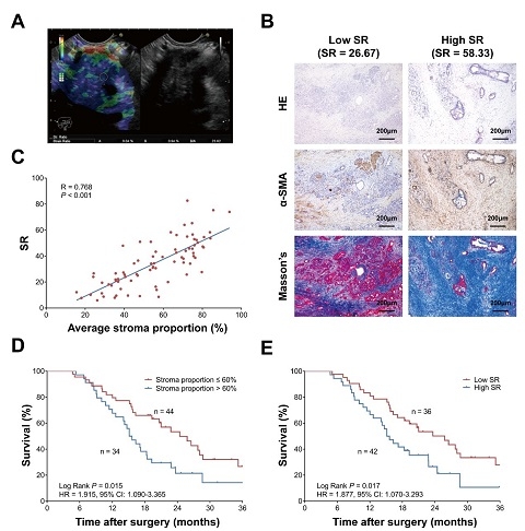 复旦大学在胰腺癌个体化化疗选择领域取得新突破